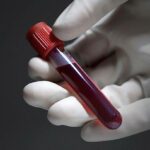 Widal Test: A Test To Confirm Typhoid Fever