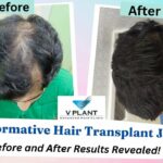 Vplant Hair Clinic Mumbai Introduces Advanced MHI Hair Transplant Technique for Painless, Scar-Free Results