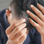What Are the Main Causes of Hair Fall in Men?